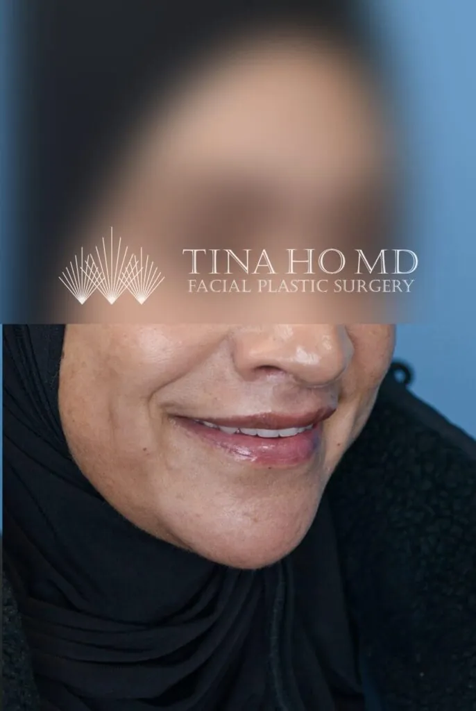 Right oblique view of patient's lips after lip augmentation