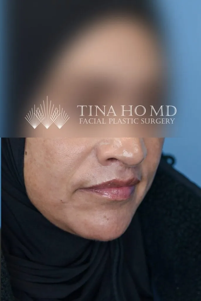 Right oblique view of patient's lips after lip lift treatment