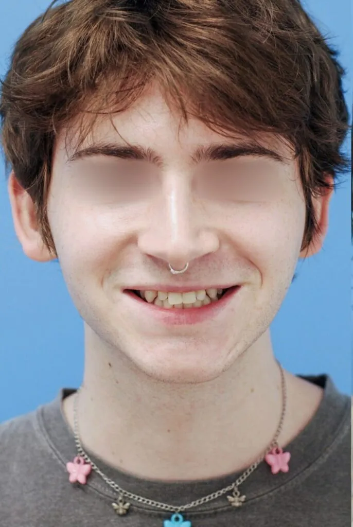 Patient's frontal view before chin augmentation procedure