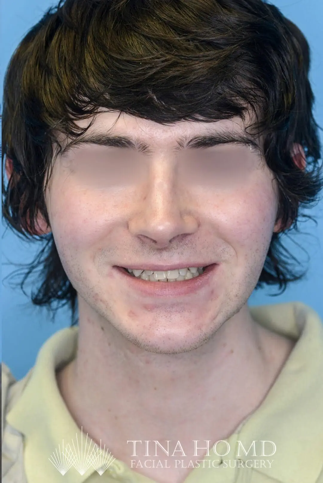 Patient's frontal view after chin augmentation procedure