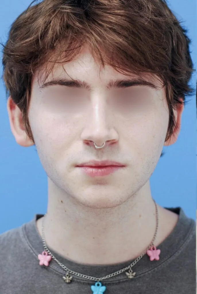 Patient's frontal view before chin implant surgery