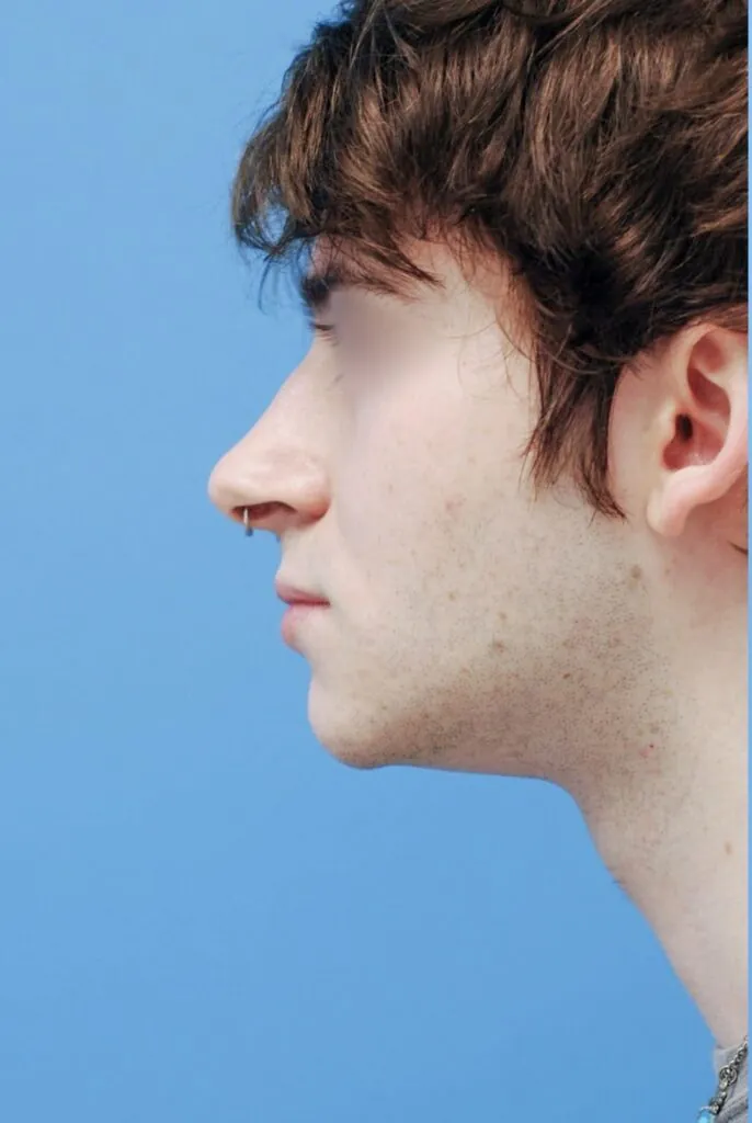 Patient's left lateral view before chin augmentation surgery