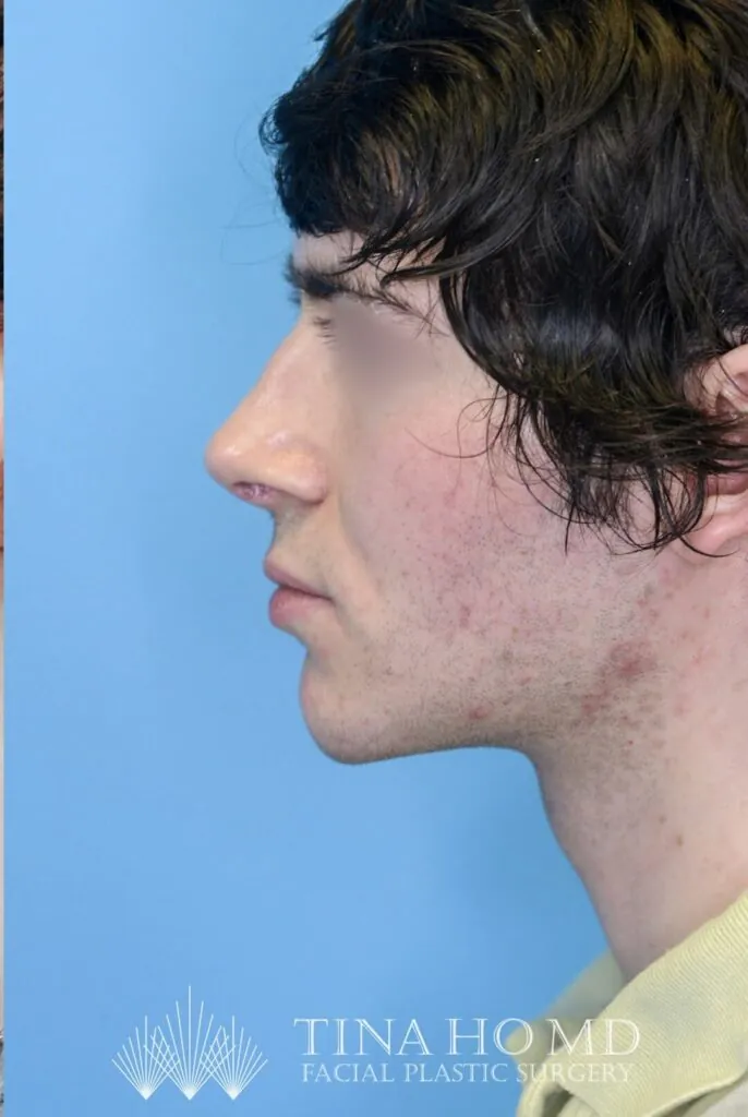 Patient's left lateral view after chin augmentation surgery