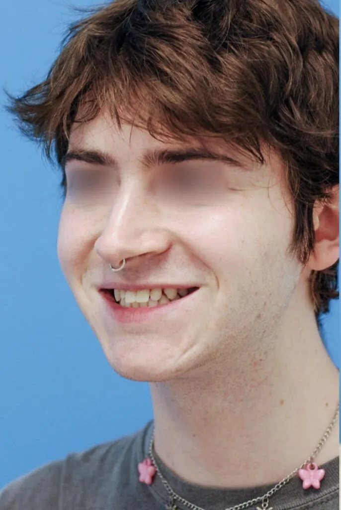 Patient's left oblique profile before chin augmentation for improved symmetry