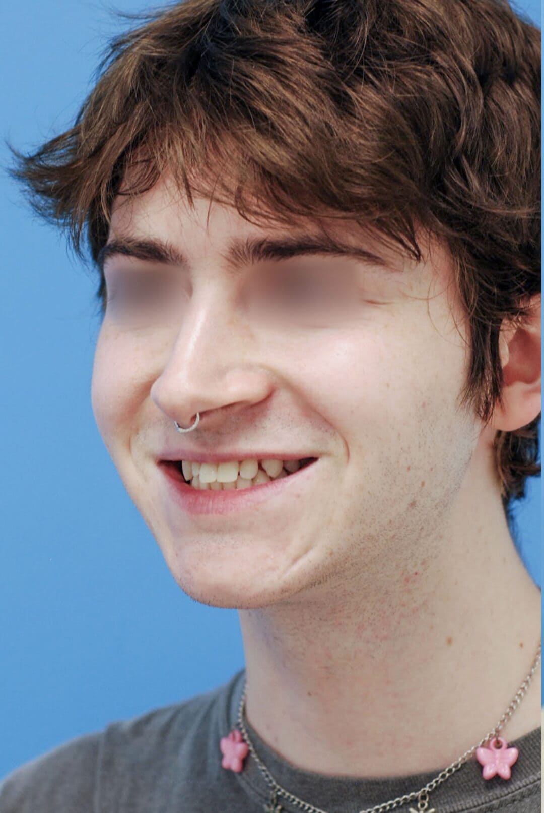 Patient's left oblique profile before chin augmentation for improved symmetry