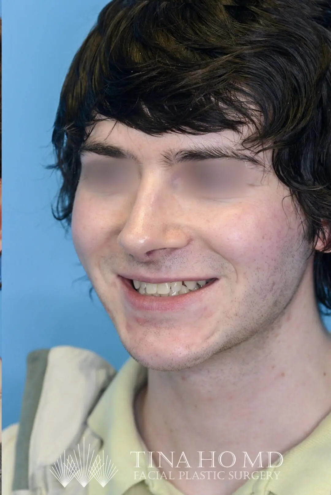 Patient's left oblique profile after chin augmentation shows improved symmetry