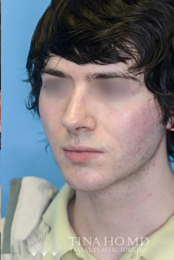 Patient's left oblique view after chin augmentation procedure