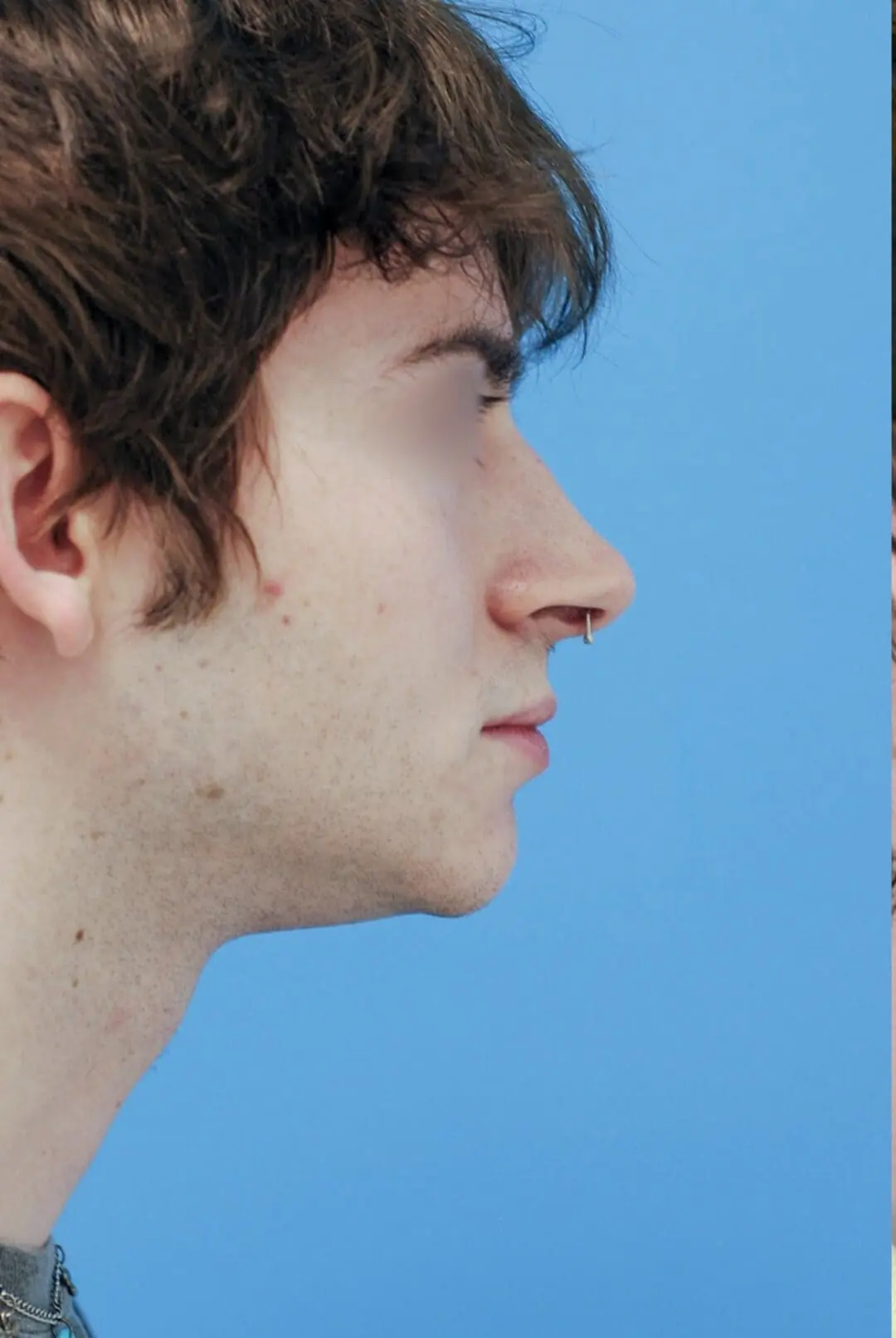 Patient's right lateral view before chin augmentation surgery