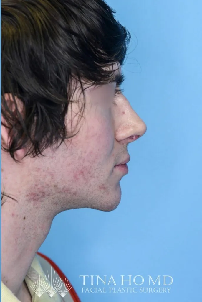 Patient's right lateral view after chin augmentation surgery