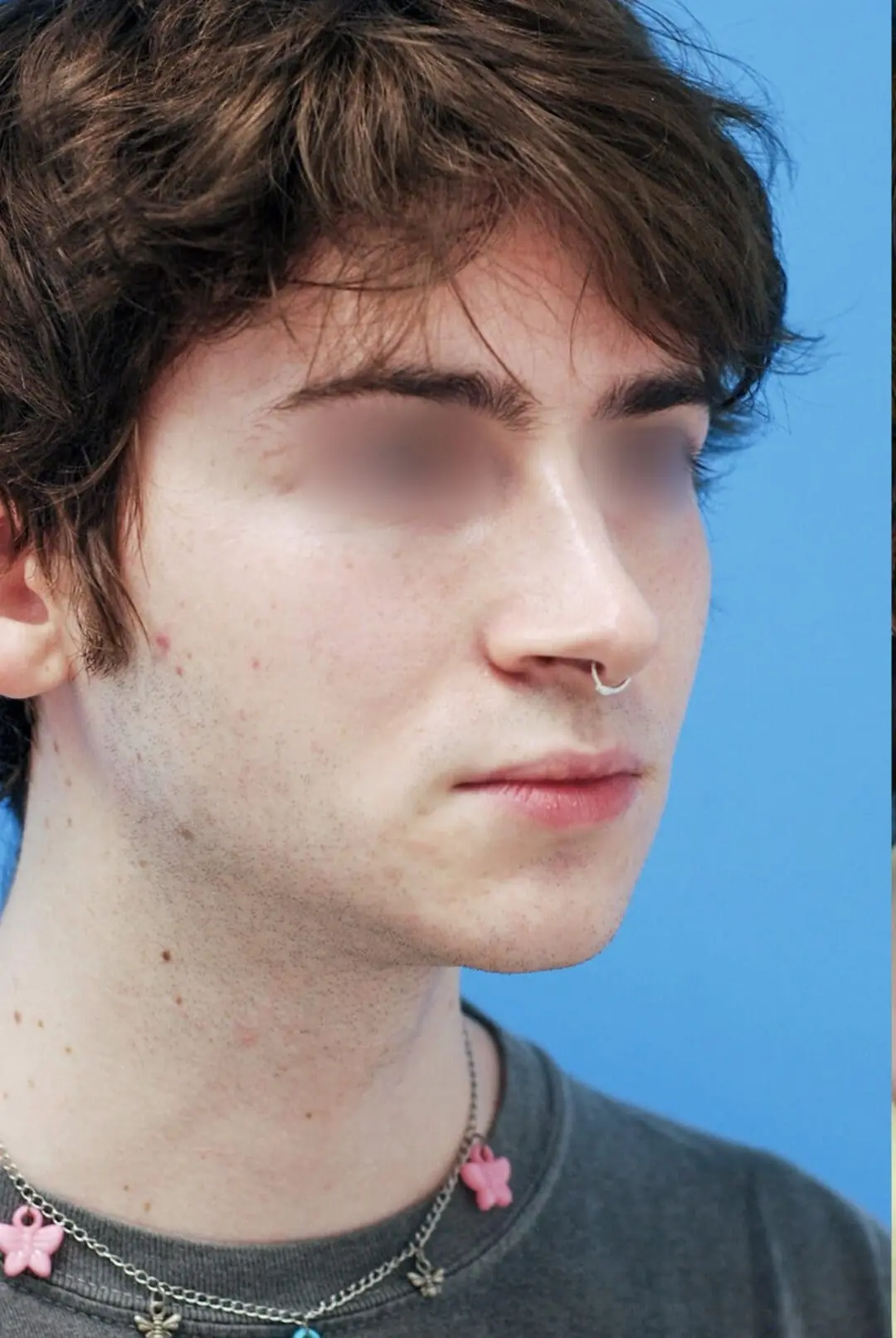 Patient's right oblique view before chin augmentation surgery