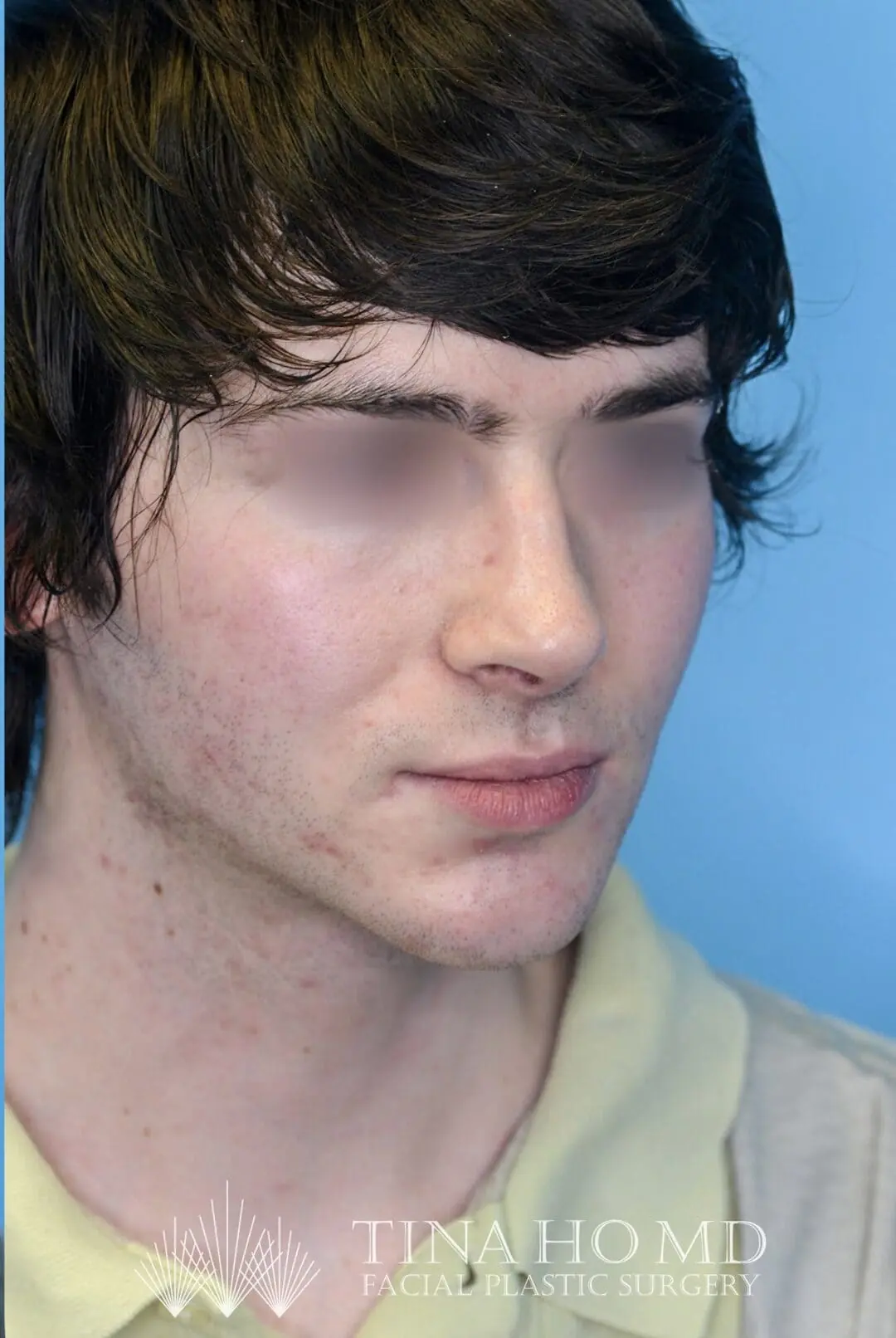 Patient's right oblique view after chin augmentation surgery