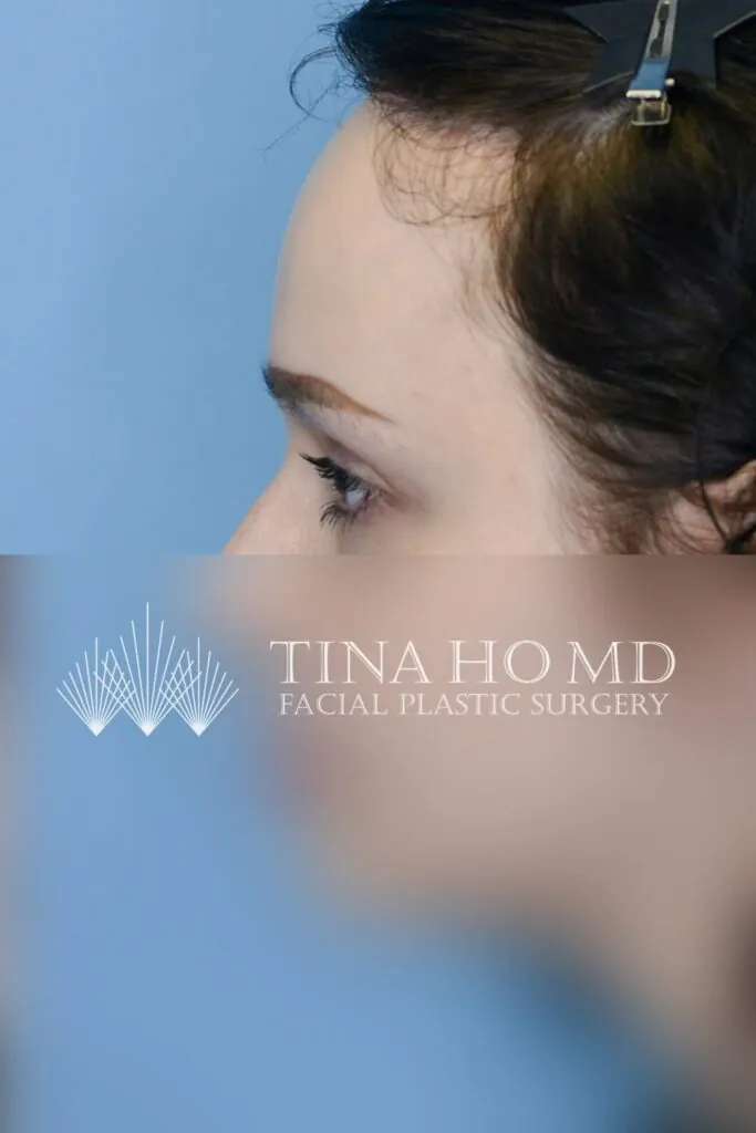 Patient after forehead reduction, left side view with lowered hairline