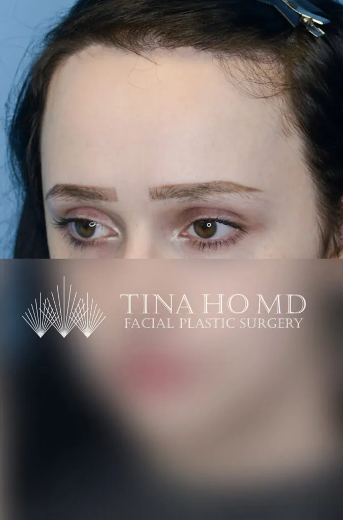 Patient after forehead reduction, left oblique view with lowered hairline