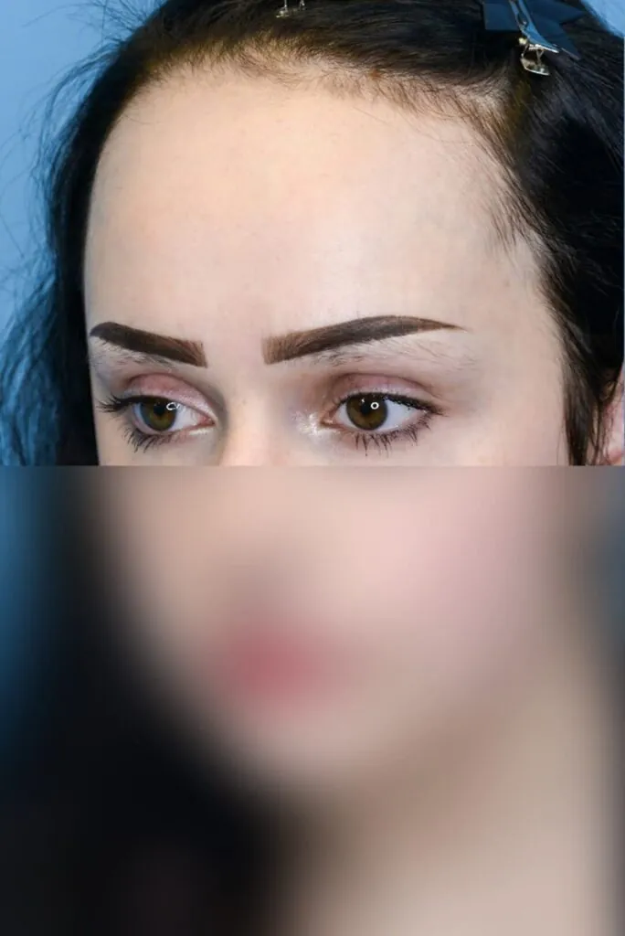 Patient before forehead reduction, left oblique view showing high hairline