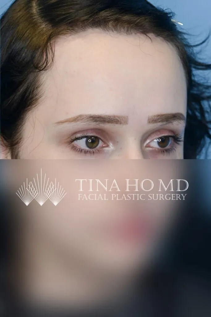 Patient after forehead reduction, right oblique view with lowered hairline