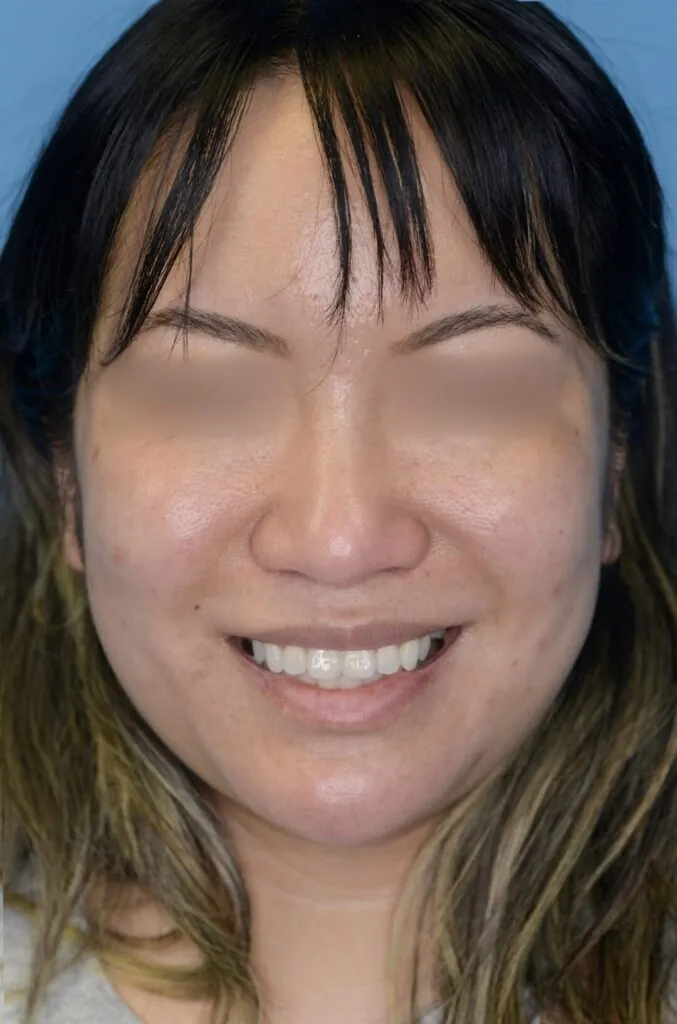 Patient KT's frontal view before jawline contouring procedure