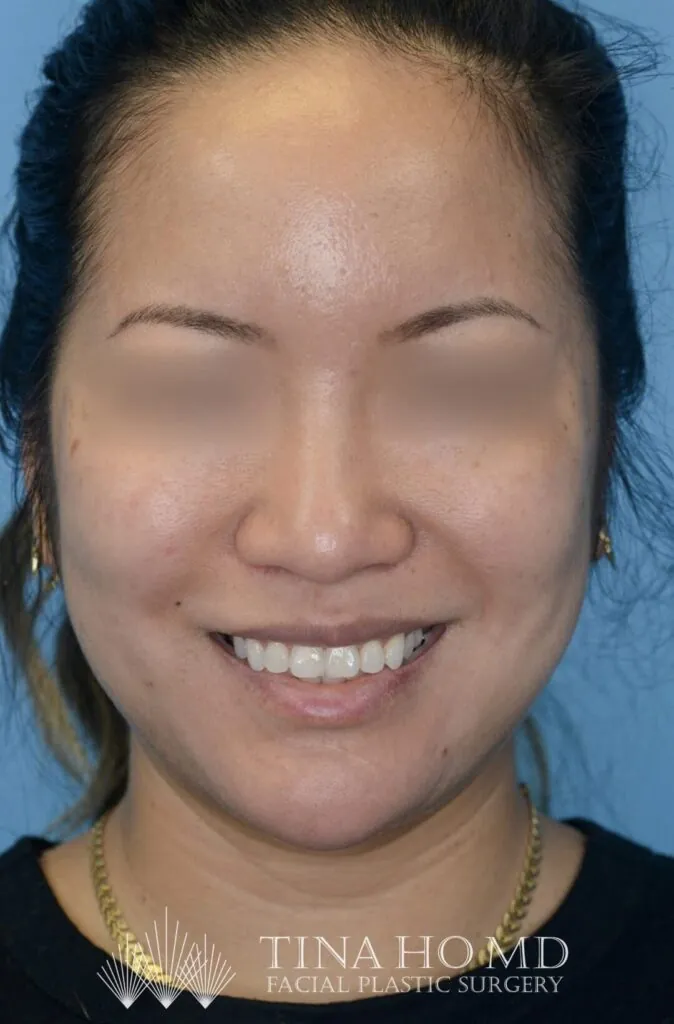Patient KT's frontal view after jawline contouring procedure