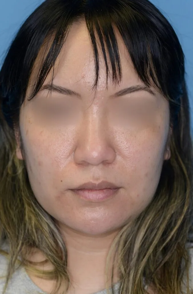 Patient KT's frontal view before jawline contouring procedure