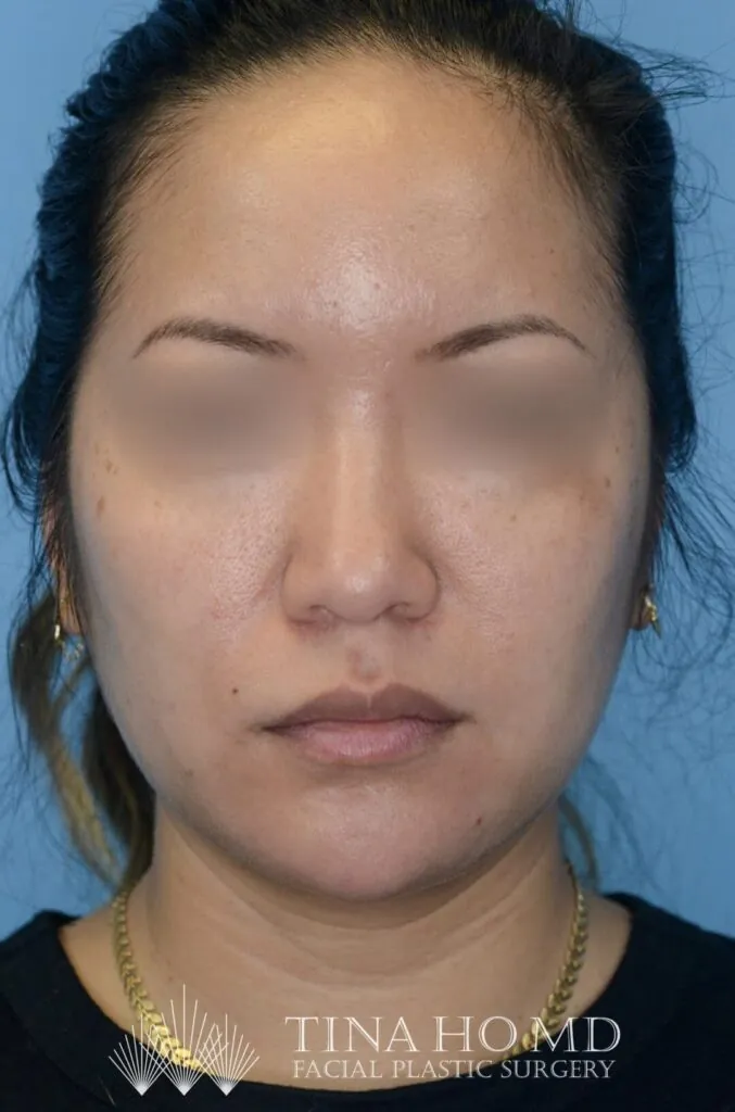 Patient KT's frontal view after jawline contouring procedure