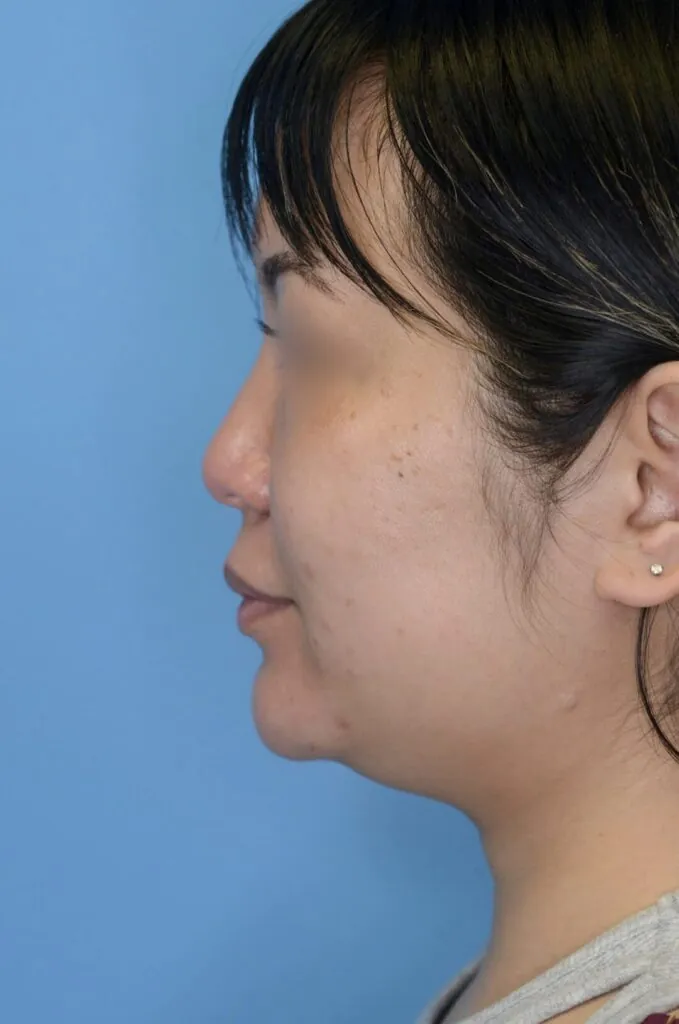 Patient KT's left lateral view before jawline contouring