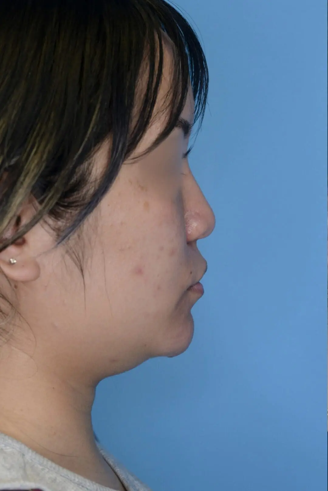 Patient KT's right lateral view before jawline contouring