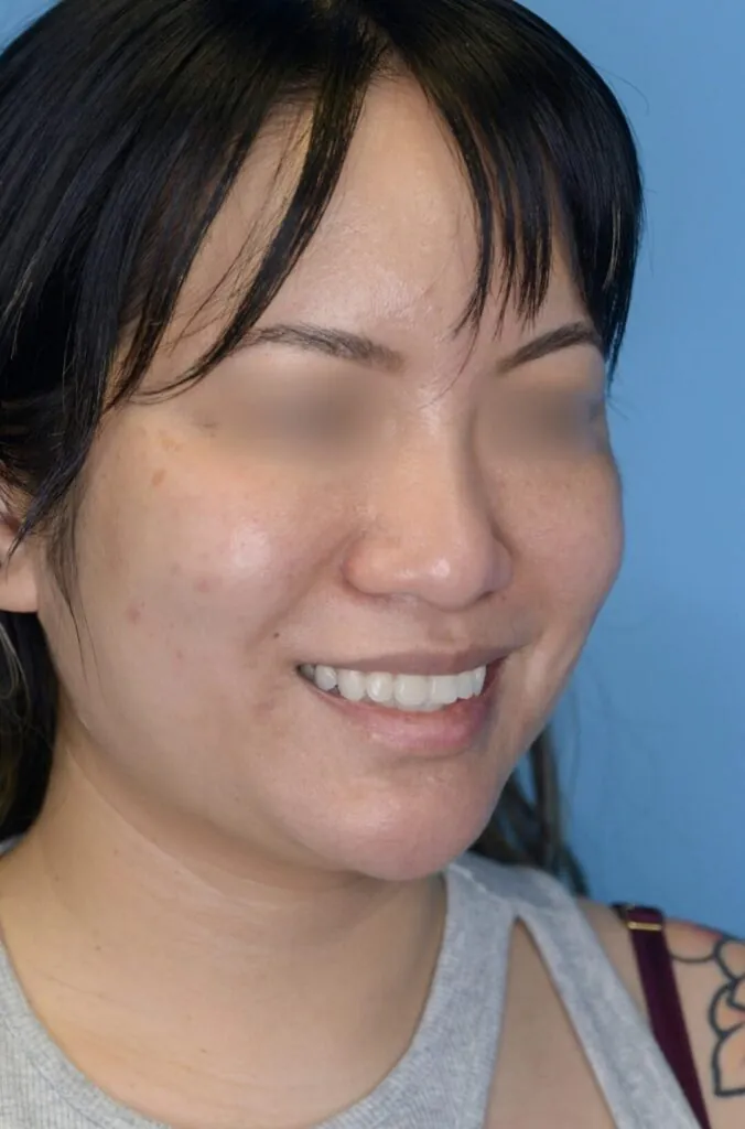 Patient KT's right oblique view before jawline contouring