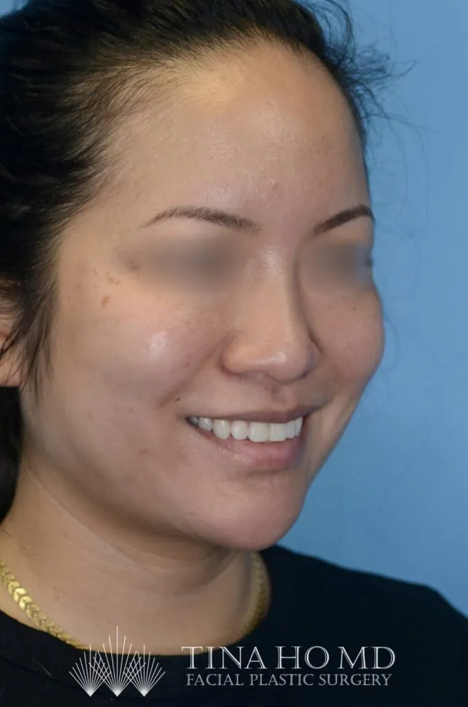 Patient KT's right oblique view after jawline contouring