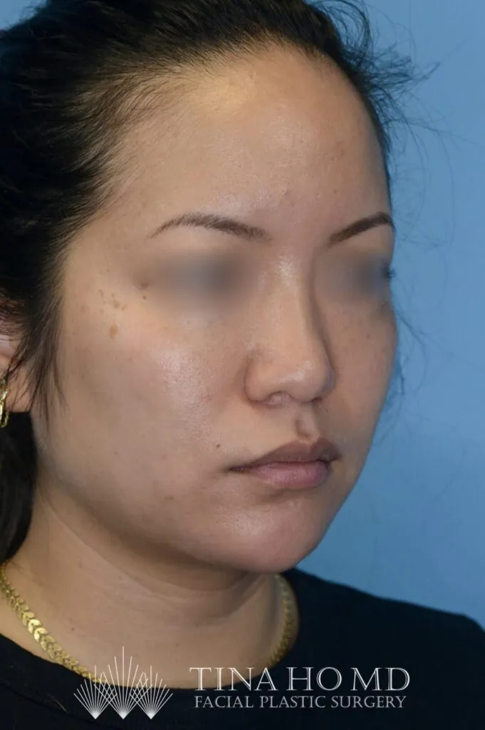 Patient KT's right oblique view after jawline contouring