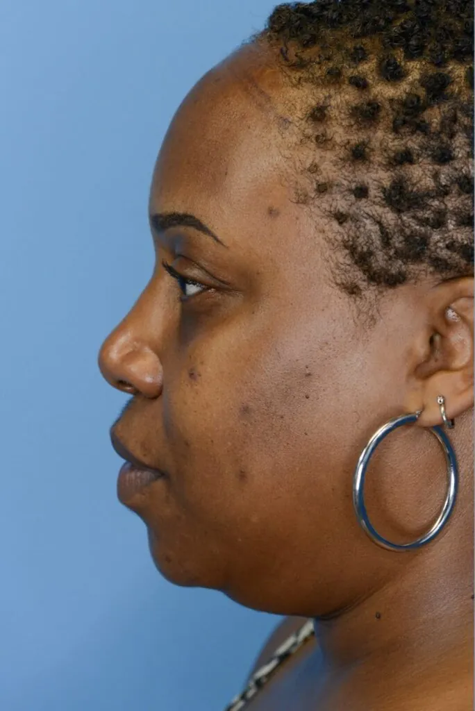 Patient before forehead reduction, left side view showing high hairline