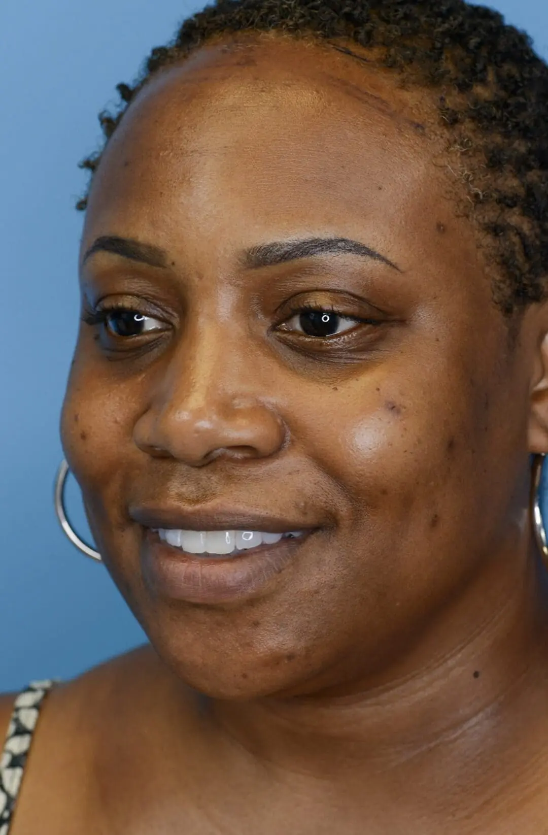 Patient before forehead reduction, left oblique view showing hairline