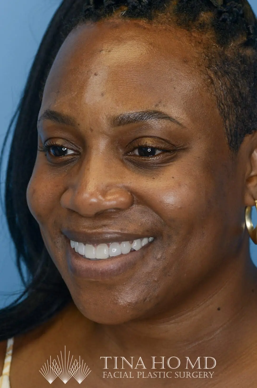 Patient after forehead reduction, left oblique view with lowered hairline