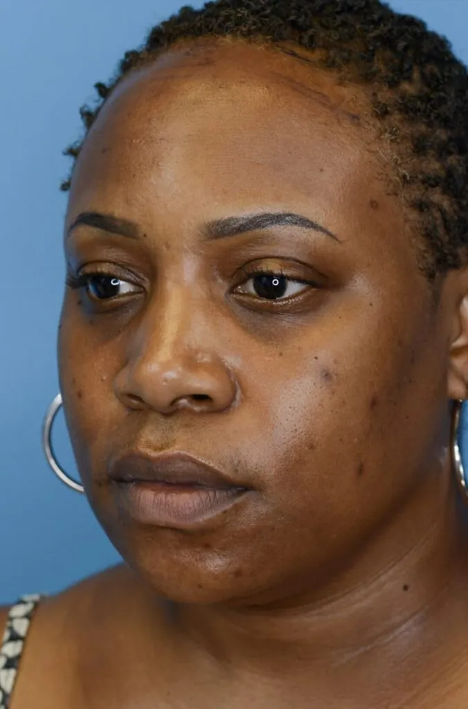 Patient before forehead reduction, left oblique view showing high hairline