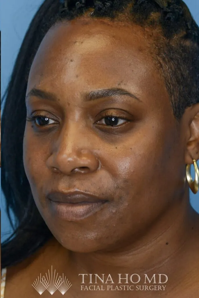 Patient after forehead reduction, left oblique view with lowered hairline