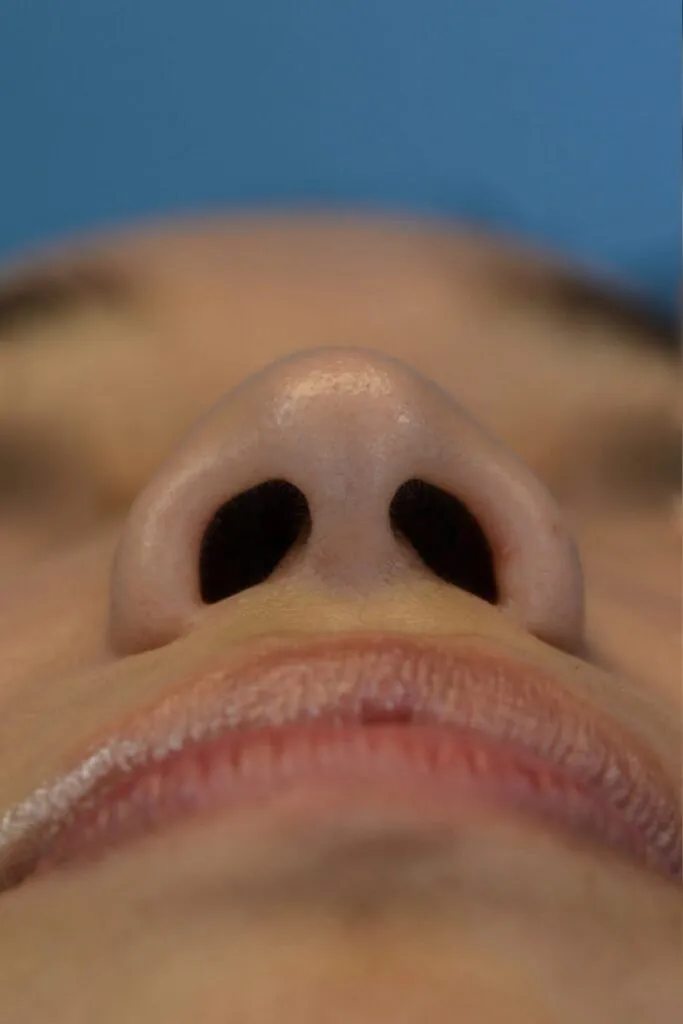 Patient AG's basal view before rhinoplasty surgery