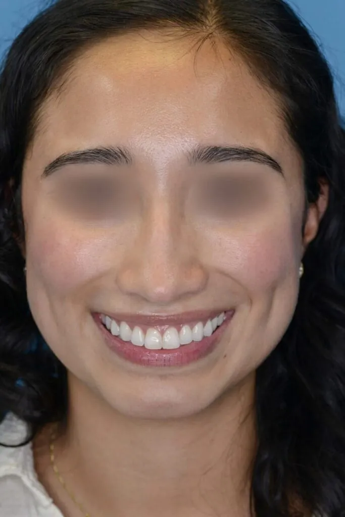 Patient AG's second frontal view before rhinoplasty surgery