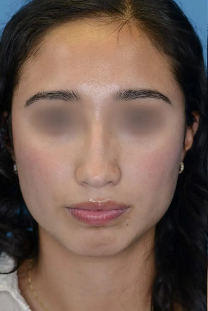 Patient AG's frontal view before rhinoplasty surgery