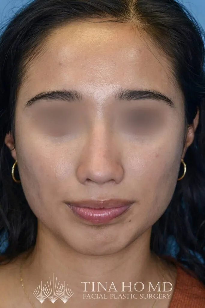 Patient AG's improved frontal view after rhinoplasty surgery