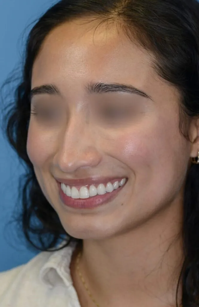 Patient AG's second left oblique view before rhinoplasty