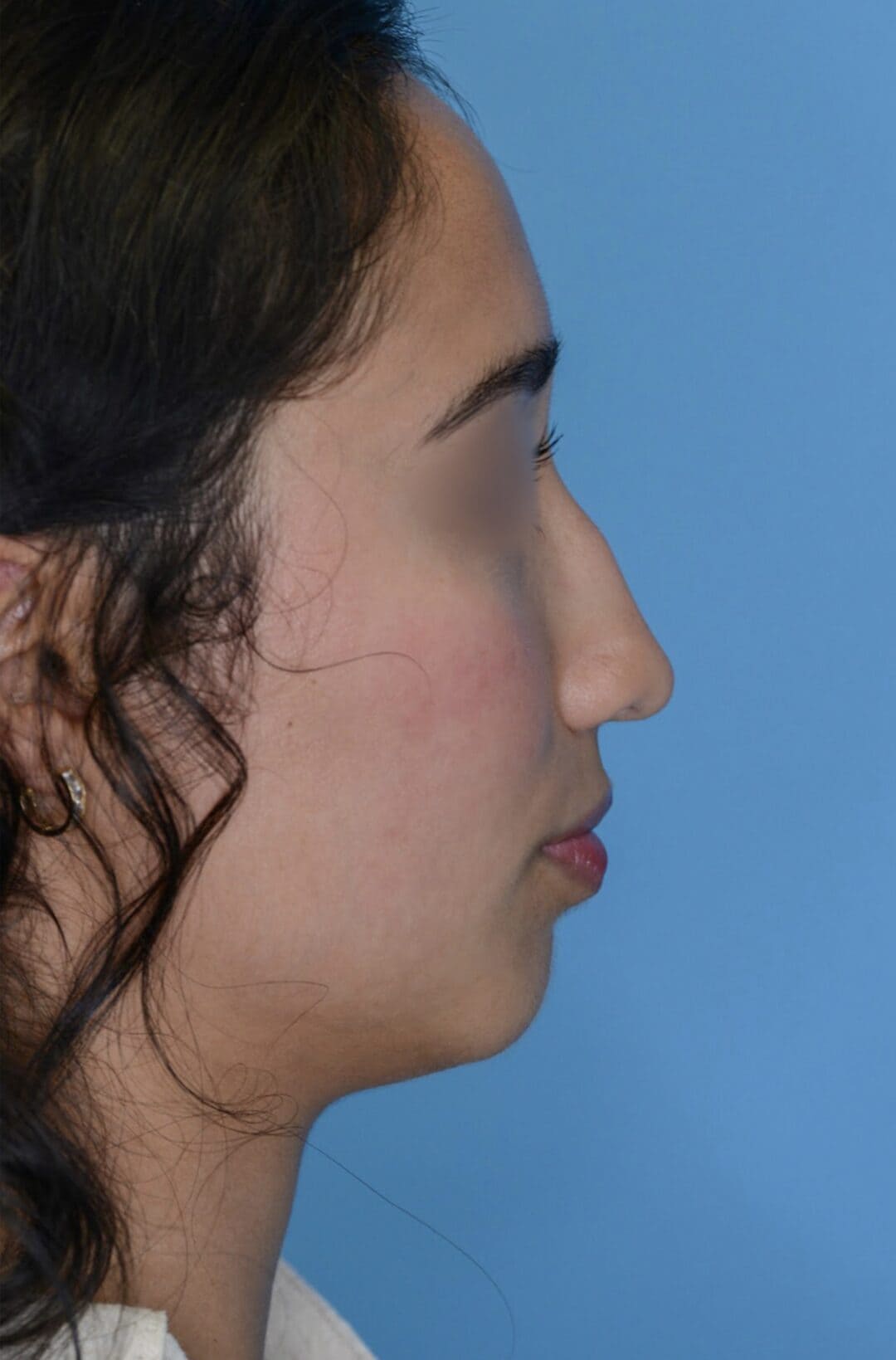 Patient AG's right lateral profile before rhinoplasty surgery