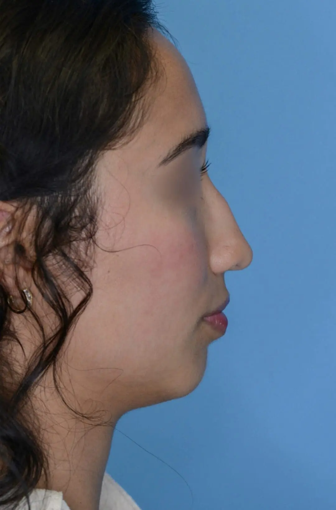 Patient AG's right lateral profile before rhinoplasty surgery