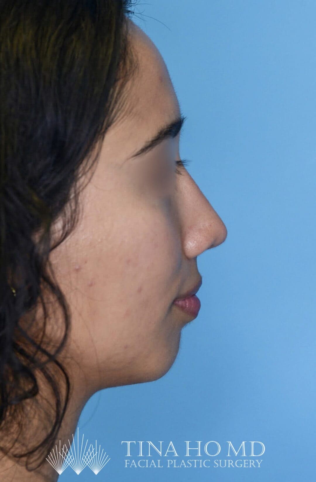 Patient AG's improved right lateral profile after rhinoplasty