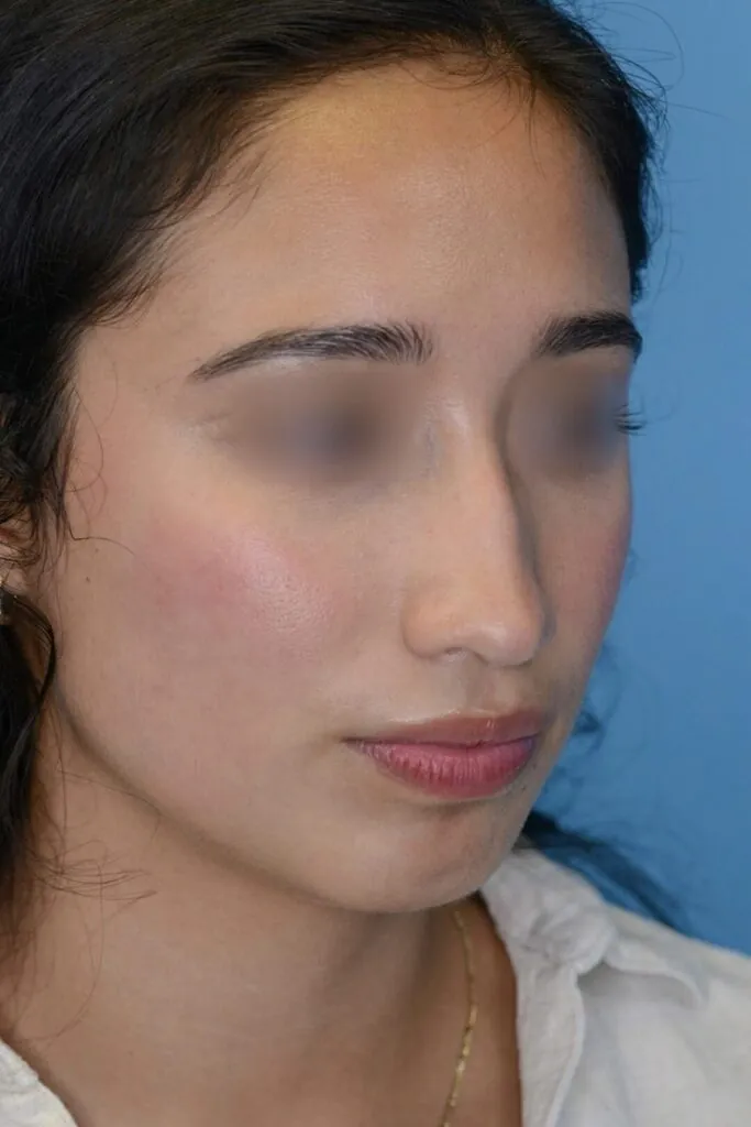 Patient AG's right oblique view before rhinoplasty surgery