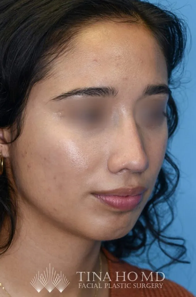 Patient AG's improved right oblique view after rhinoplasty