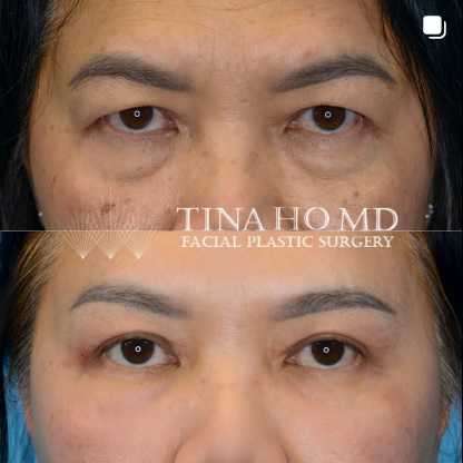 Upper and Lower Eyelid Surgery Before and After