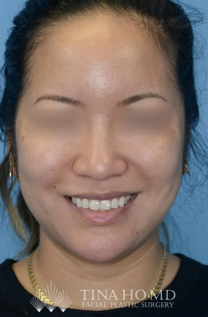 Patient's frontal view after chin augmentation, jawline contouring, and facial injectable procedure