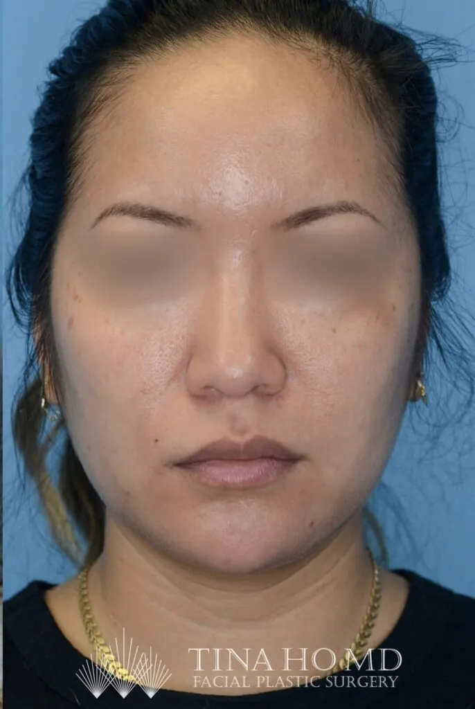 Patient's frontal view after chin augmentation, jawline contouring, and facial injectable procedure