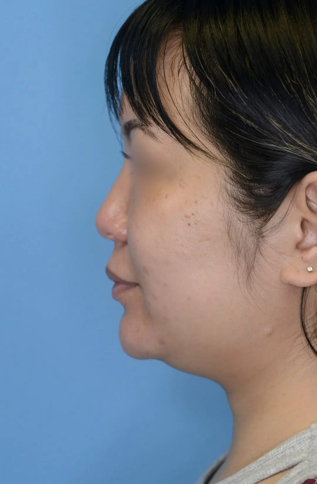 Patient's left lateral view before chin augmentation, jawline contouring, and facial injectable procedure