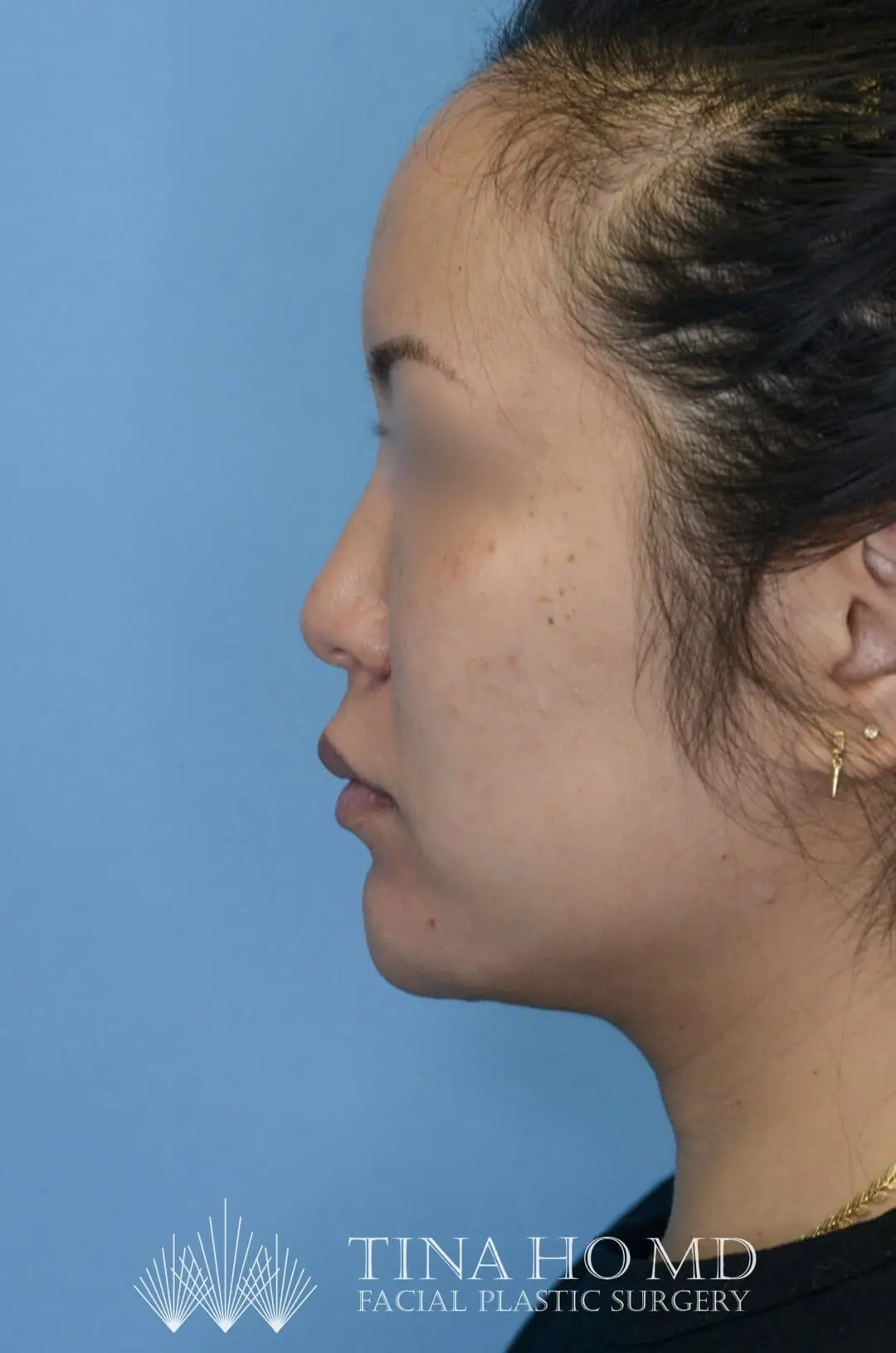 Patient's left lateral view after chin augmentation, jawline contouring, and facial injectable procedure