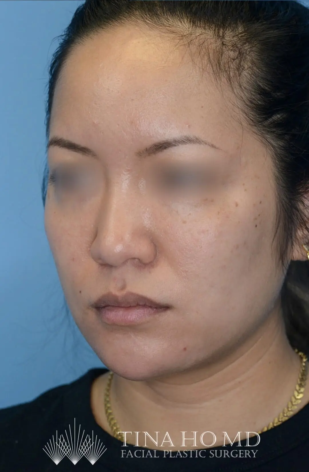 Patient's left oblique view after chin augmentation, jawline contouring, and facial injectable procedure