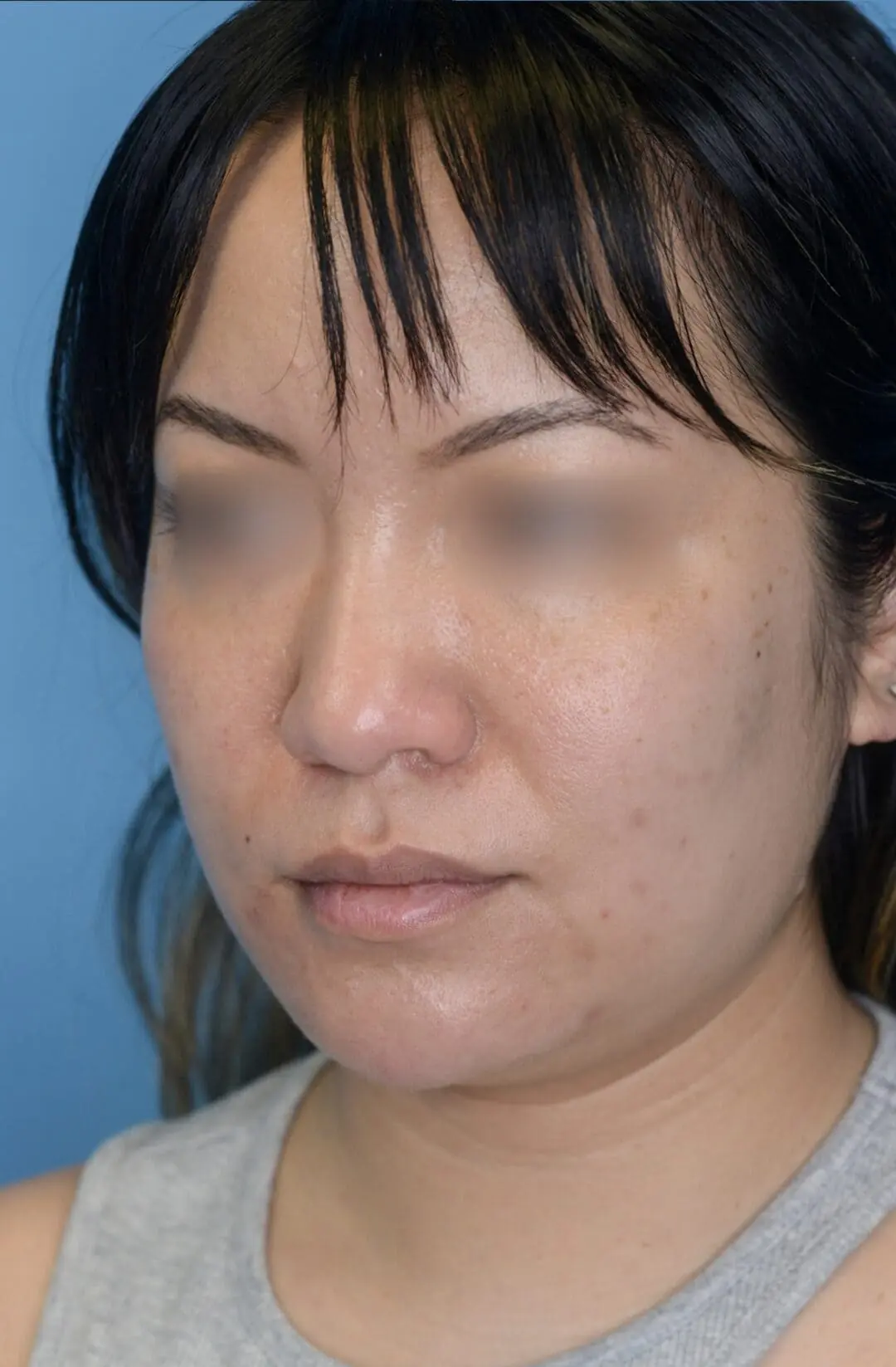 Patient's left oblique view before chin augmentation, jawline contouring, and facial injectable procedure